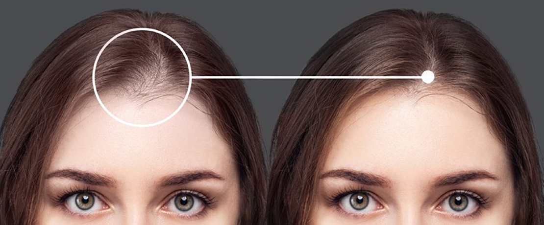 La mésothérapie capillaire avec exosomes